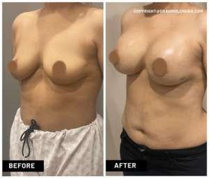 Bottoming Out and Breast Implants - Esteem Cosmetic Studio