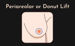Periareolars or Donut lifts