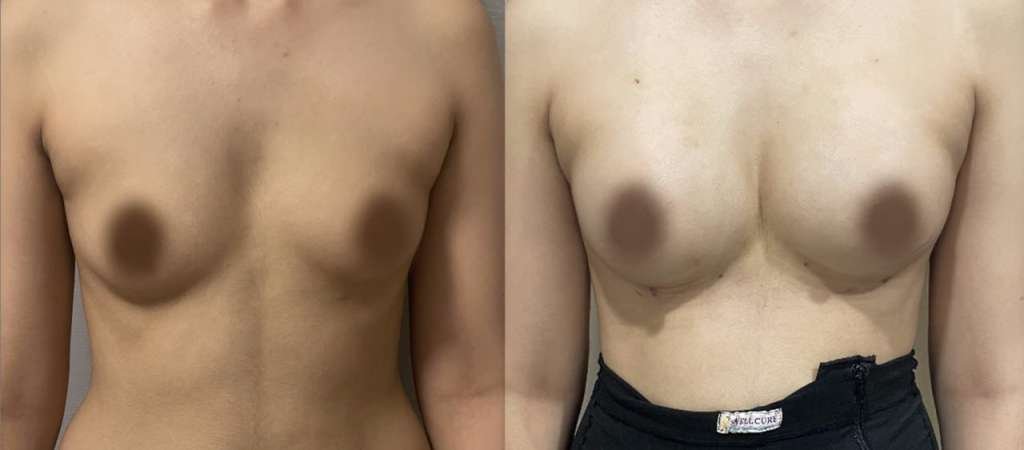 Breast Fat Transfer- Augmentation