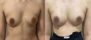 Breast Fat Transfer- Augmentation