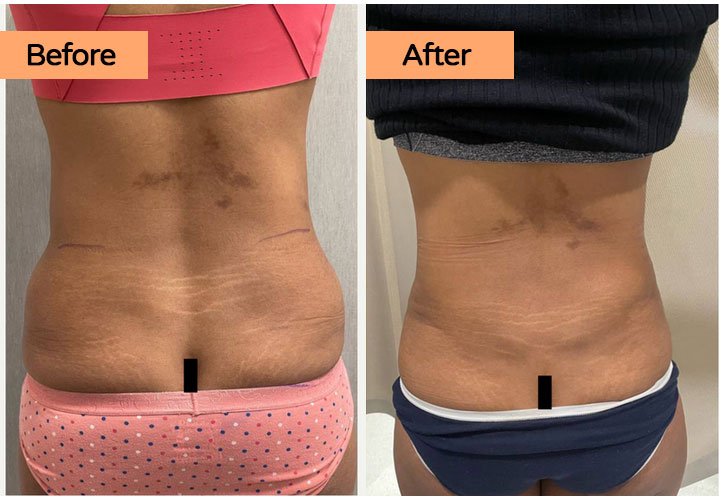 Revision Tummy Tuck and Liposuction of the love handles