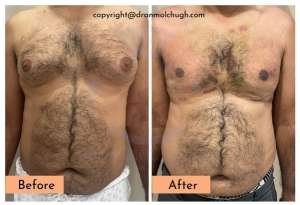 gynecomastia surgery in india