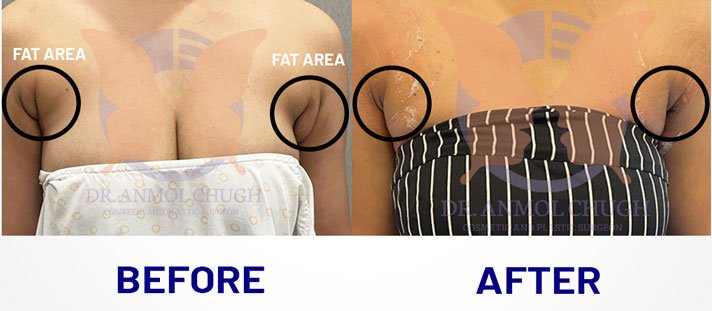 Axillary breast fat removal