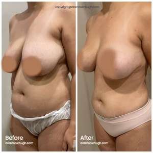 breast lift with 360 lipo