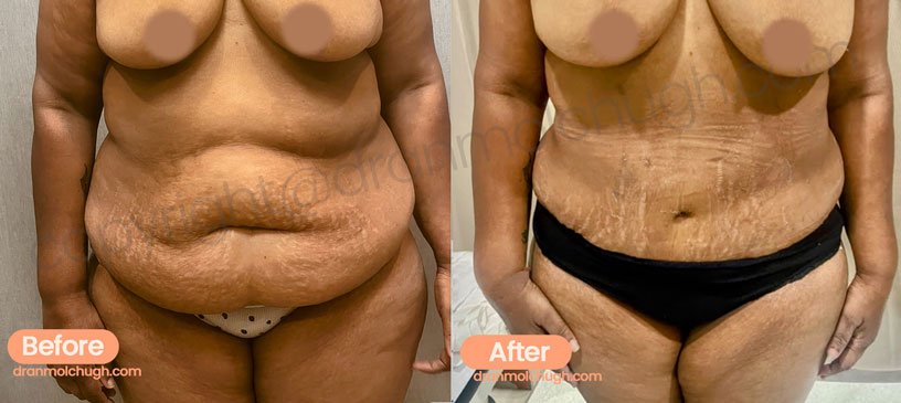 51 year old female Tummy tuck with 360 Liposuction