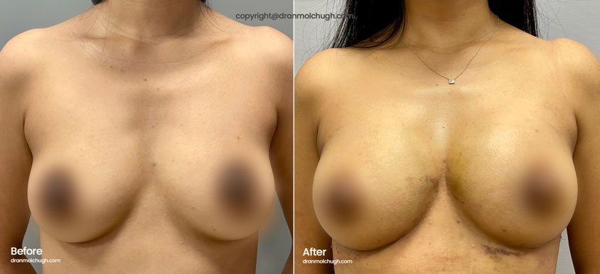 Natural Breast Augmentation