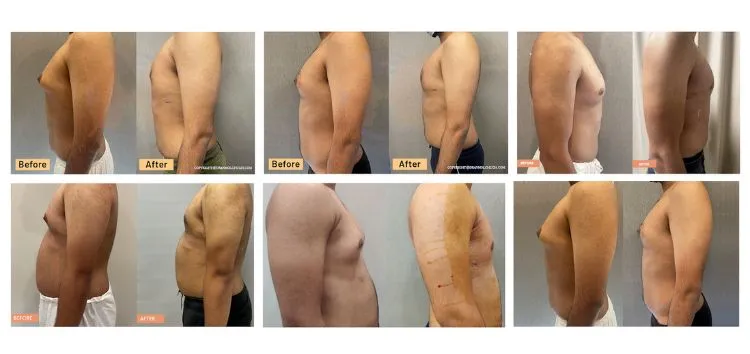 How does gynecomastia before and after real patient images help