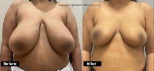Breast Reduction by Dr Anmol Chugh