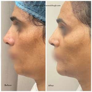 chin implant surgery results