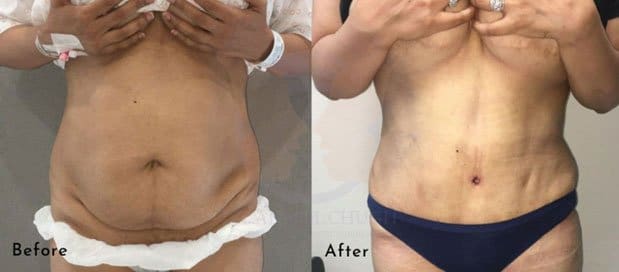 Real Patient result after tummy tuck surgery