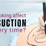 Can smoking affect liposuction recovery time
