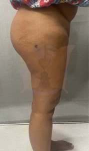 thigh liposuction after liposuction