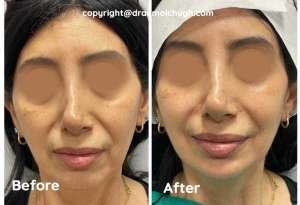 Chin and Jaw Fillers in Gurgaon