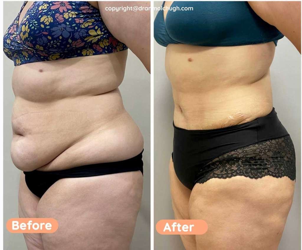 Tummy Tuck with 360 Liposuction 3 months post surgery 36year Female