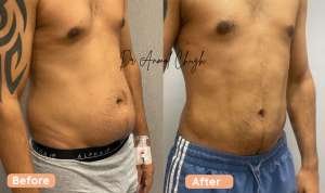 High Definition Liposuction | 40 year old male | 3 months post surgery