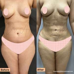 Body Liposuction Surgery in Gurgaon India