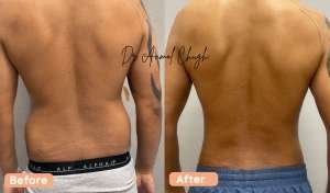Back Liposuction-High Definition Liposuction in India