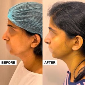 Rhinoplasty Surgery Patient Image