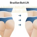 How a Brazilian Butt Lift Can Transform Your Body Shape?