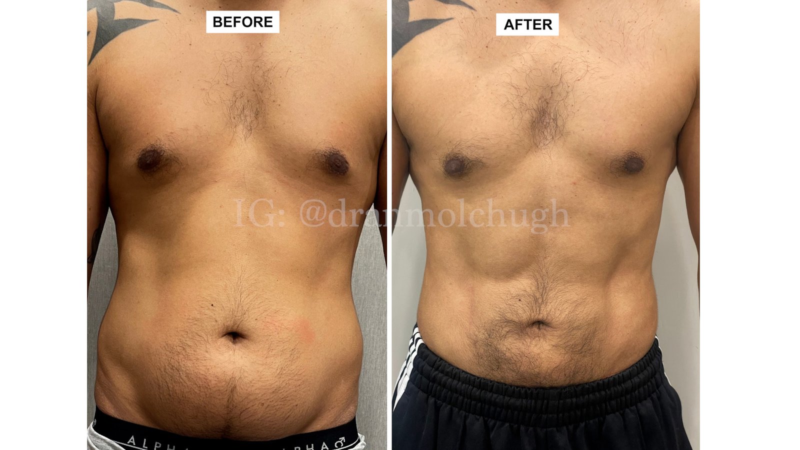 High-Definition Liposuction