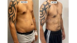 Hi definition Liposuction