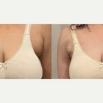 Transformative results of axillary breast reduction for a 44-year-old woman