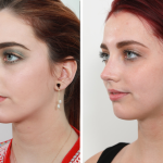 Celebrity rhinoplasty procedures for achieving the perfect nose