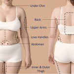 Comparing fat removal surgery and liposuction procedures