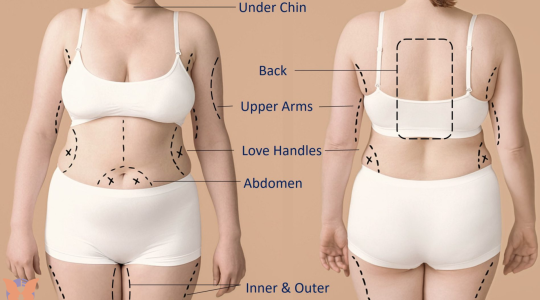 Comparing fat removal surgery and liposuction procedures