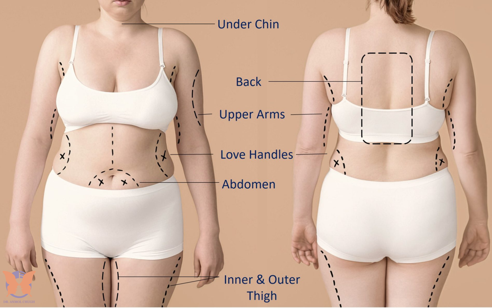 Comparing fat removal surgery and liposuction procedures