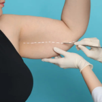 Tips for managing arm liposuction side effects for smooth recovery