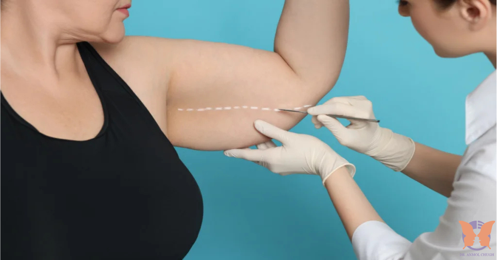 Tips for managing arm liposuction side effects for smooth recovery