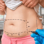 Tips for smooth recovery and healing after tummy tuck surgery