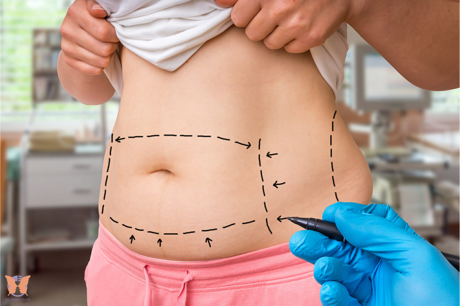 Tips for smooth recovery and healing after tummy tuck surgery