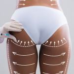 Understanding the side effects of Brazilian Butt Lift surgery