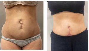 Abdominal Reconstruction with Tummy Tuck
