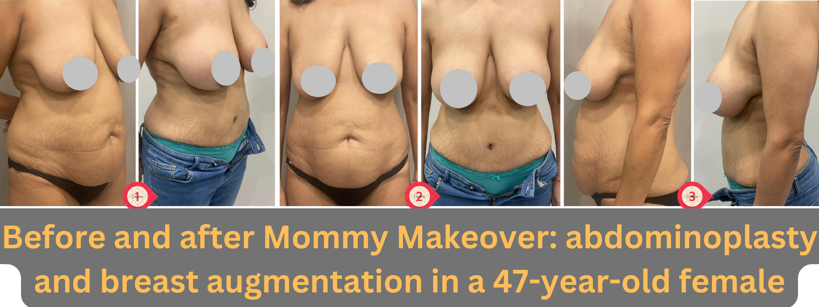 Before and after Mommy Makeover: abdominoplasty and breast augmentation in a 47-year-old female