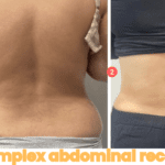 Before and after results of complex abdominal reconstruction with tummy tuck