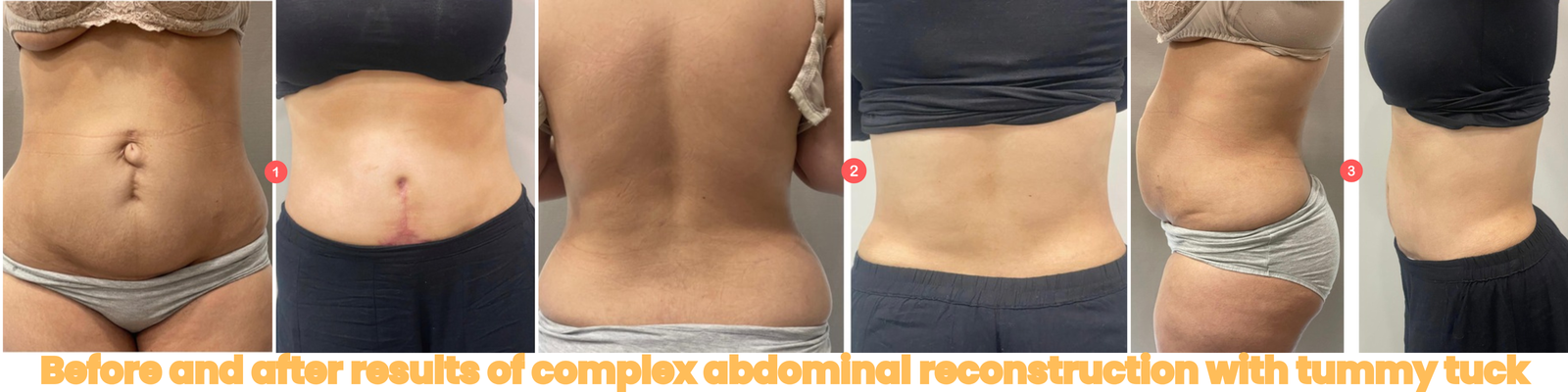 Before and after results of complex abdominal reconstruction with tummy tuck