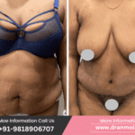 Before and after results of tummy tuck for a 50-year-old high BMI patient