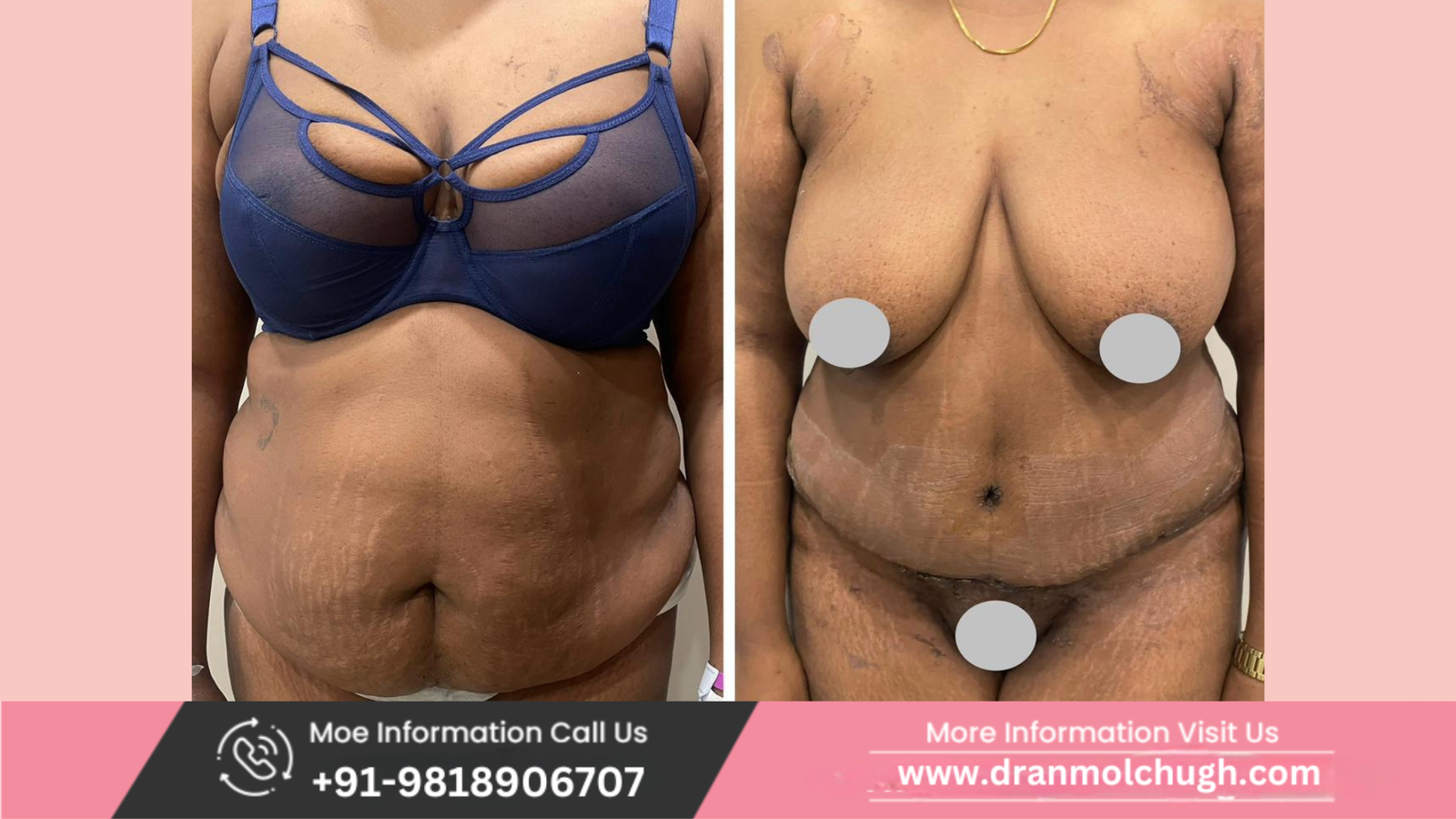 Before and after results of tummy tuck for a 50-year-old high BMI patient