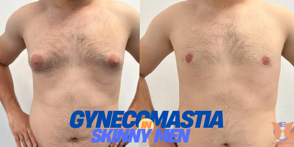 Gynecomastia in skinny men – causes, symptoms, and treatment options