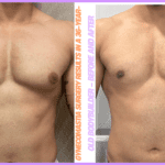 Gynecomastia surgery results in a 36-year-old bodybuilder – before and after