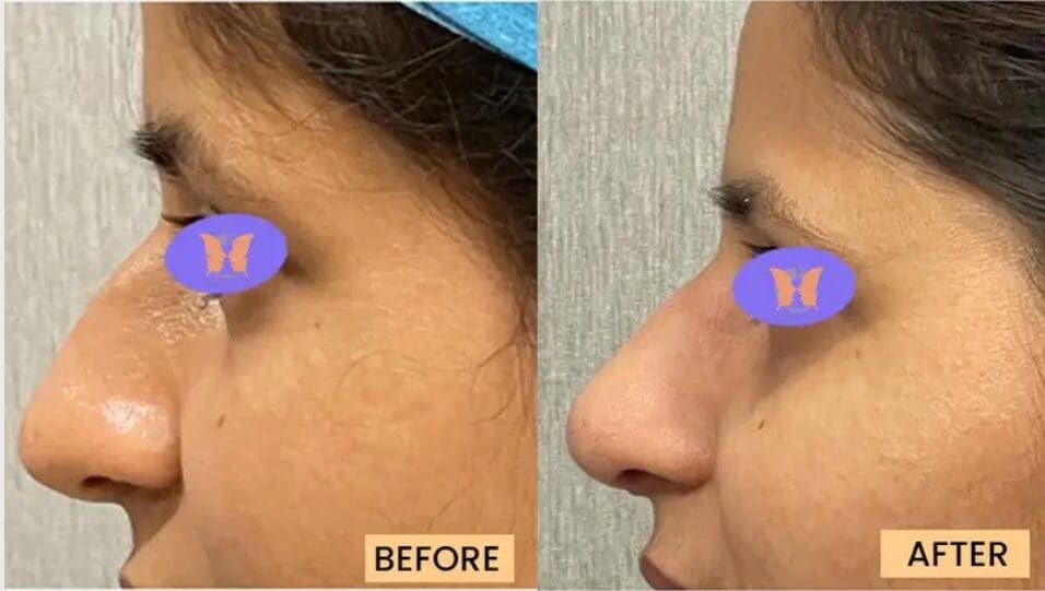 Real Patient Result After Rhinoplasty