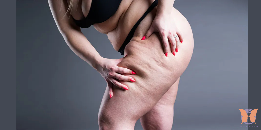 Lipedema Surgery in India – Specialized Care for International Patients with Chronic Fat Disorder