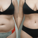 Liposuction before and after results – visible transformation of abdomen and waistline