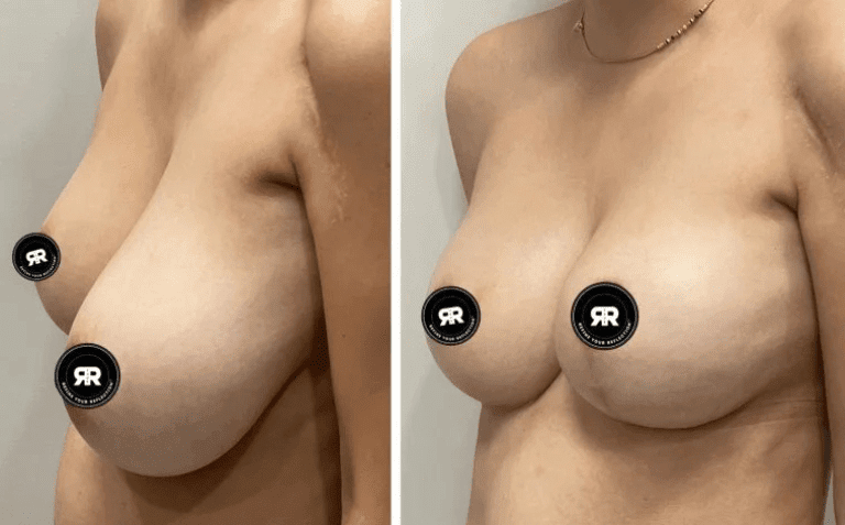 Breast Reduction with lift, 28-year-old female, 1 year post op