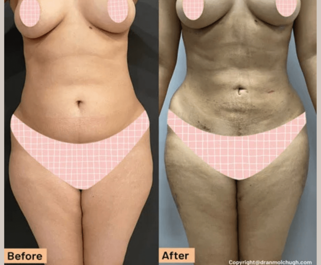 Tummy Tuck with High definition 360 Liposuction with thigh liposuction – 1 week postop