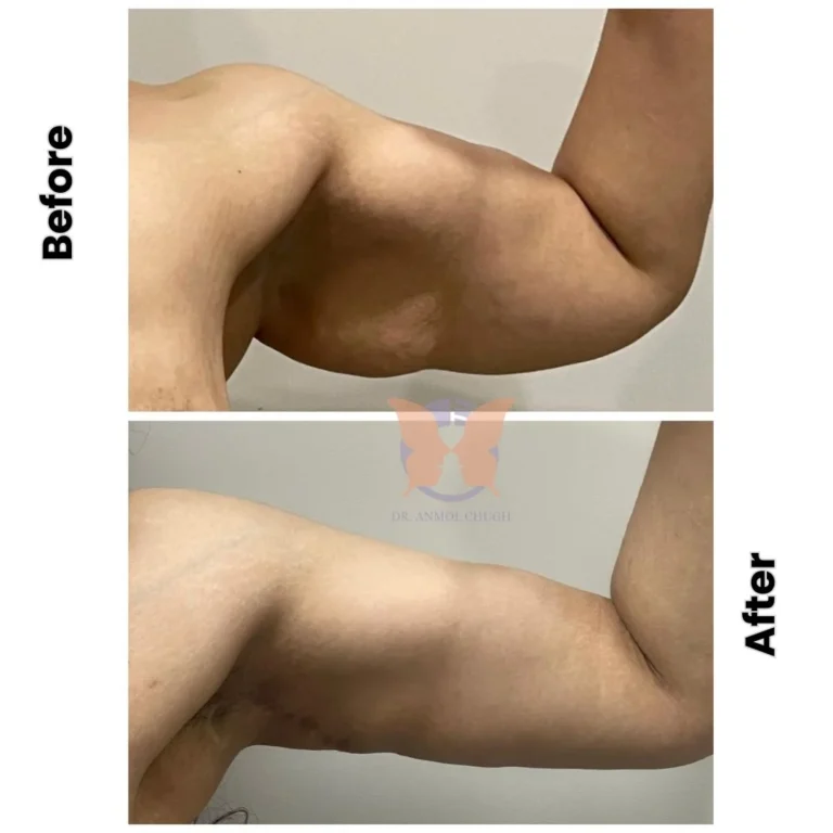 23-Year-Old Lady | 3 Months Post-Op | Post Weight Loss Transformation