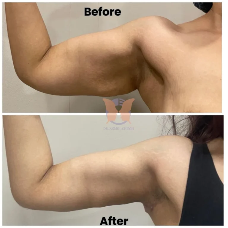 23-Year-Old Lady | 3 Months Post-Op | Post Weight Loss Transformation